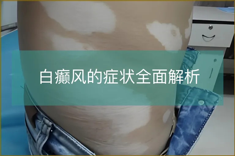 白癫风的症状全面解析