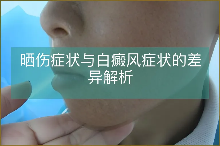 晒伤症状与白癜风症状的差异解析