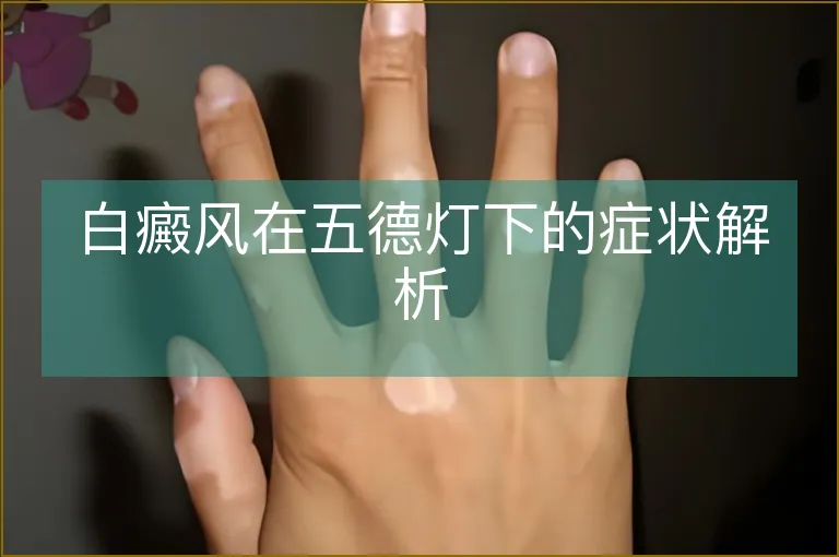 白癜风在五德灯下的症状解析