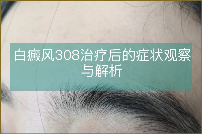 白癜风308治疗后的症状观察与解析