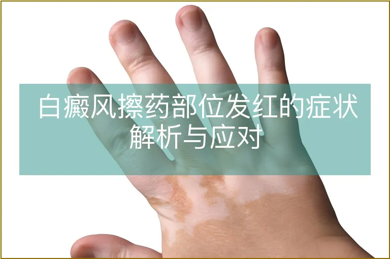 白癜风擦药部位发红的症状解析与应对