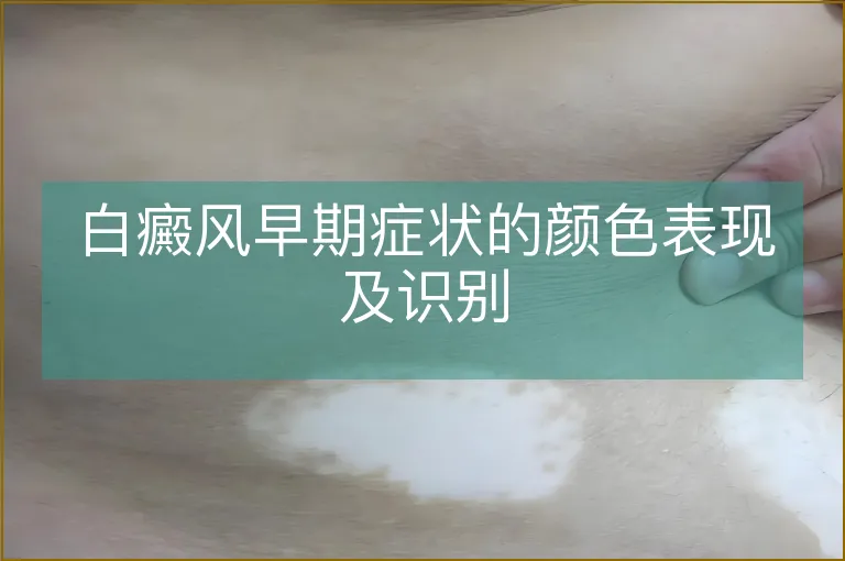 白癜风早期症状的颜色表现及识别