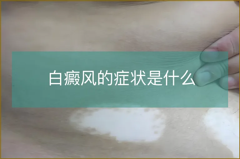 白癜风的症状是什么