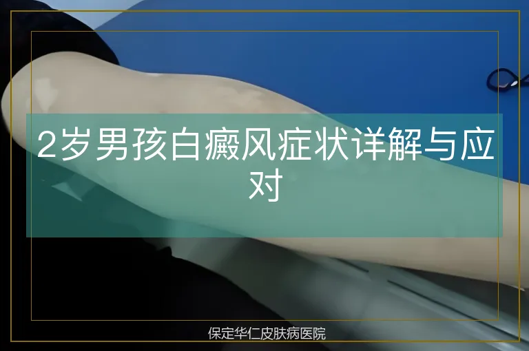 2岁男孩白癜风症状详解与应对