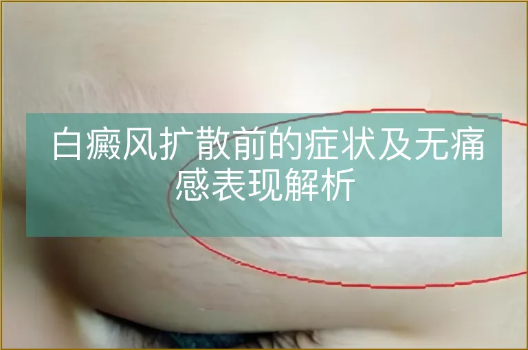 白癜风扩散前的症状及无痛感表现解析