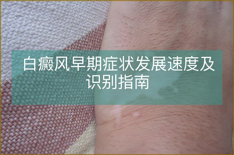 白癜风早期症状发展速度及识别指南