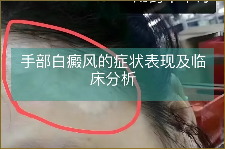 手部白癜风的症状表现及临床分析