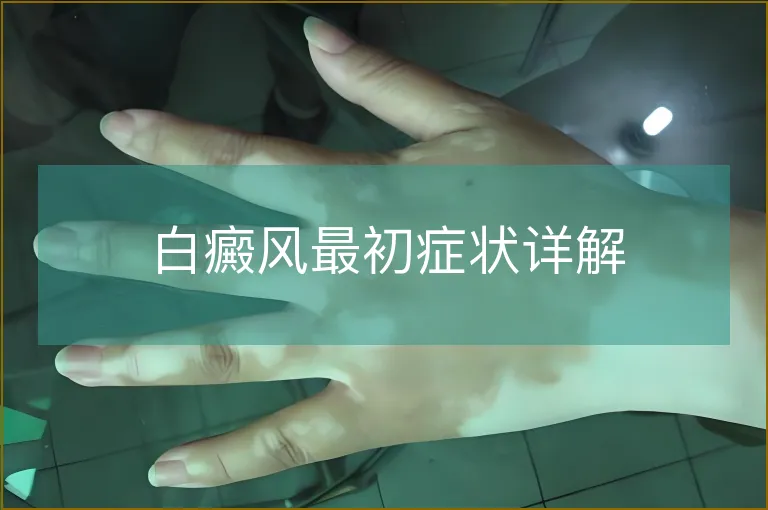 白癜风最初症状详解