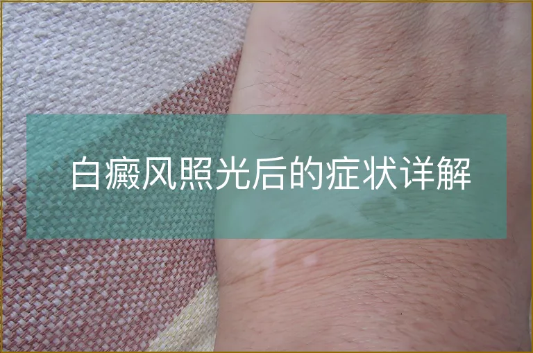 白癜风照光后的症状详解