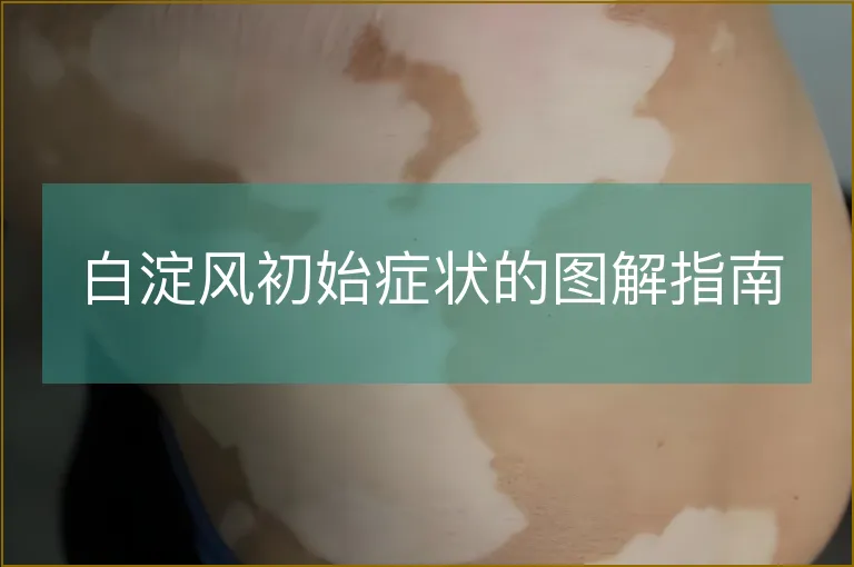 白淀风初始症状的图解指南