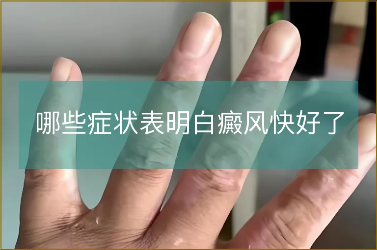 哪些症状表明白癜风快好了