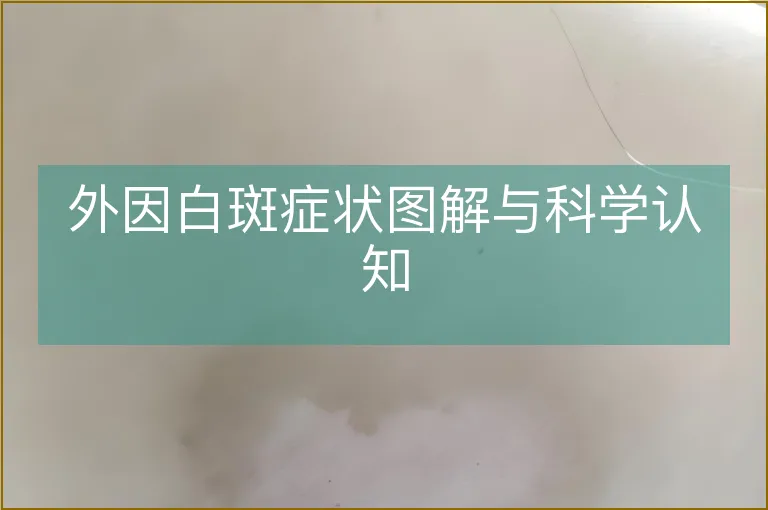 外因白斑症状图解与科学认知