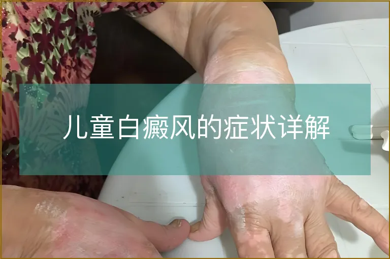 儿童白癜风的症状详解