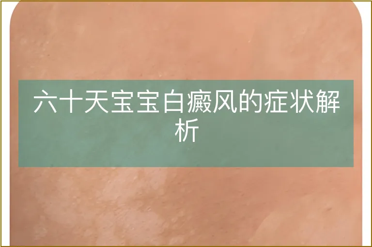 六十天宝宝白癜风的症状解析