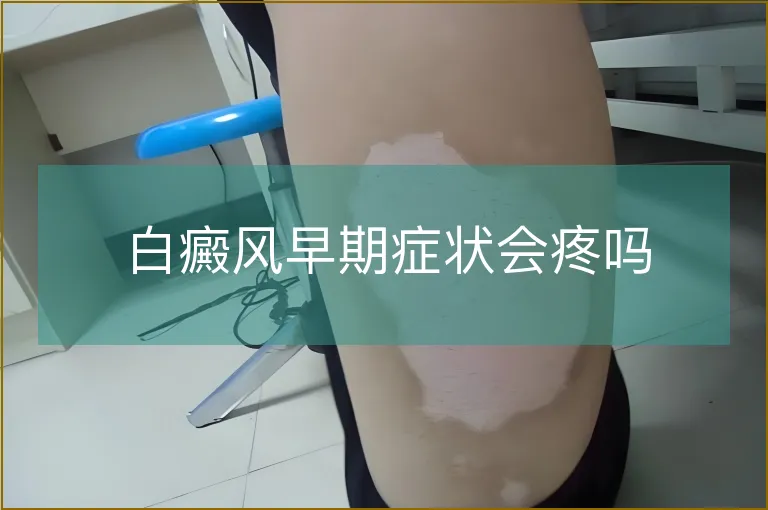 白癜风早期症状会疼吗