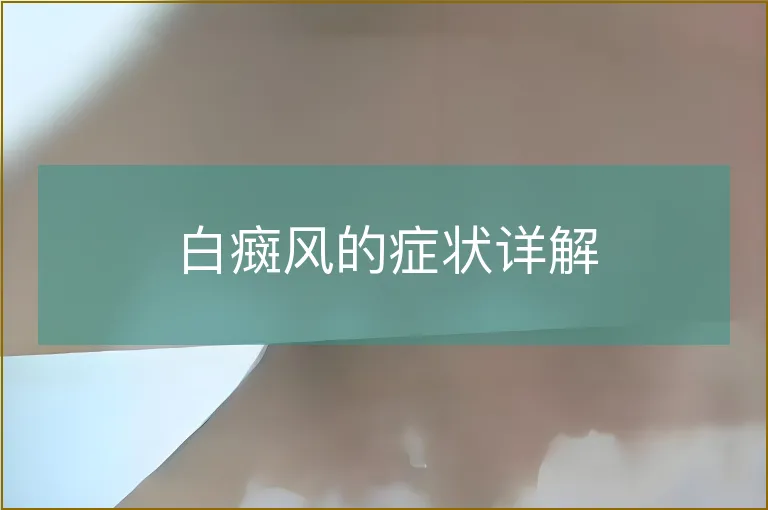 白癍风的症状详解