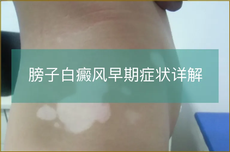 膀子白癜风早期症状详解